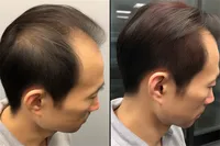 中德植发百科的手术安全性如何保证？